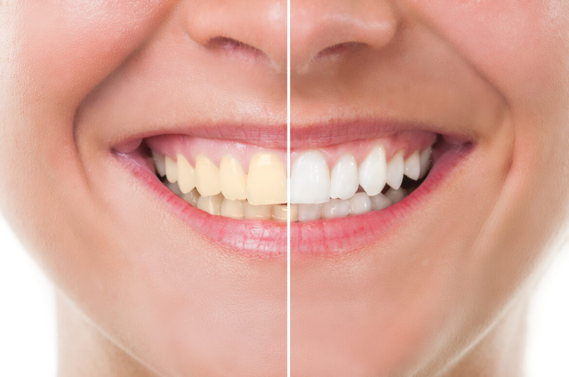Understanding Teeth Whitening Procedures