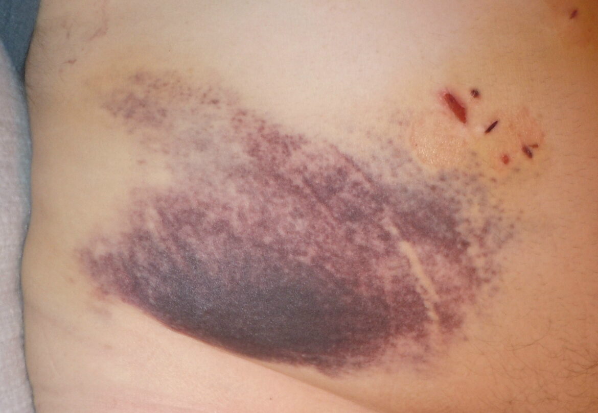 What To Expect Before, During, and After Gallbladder Surgery