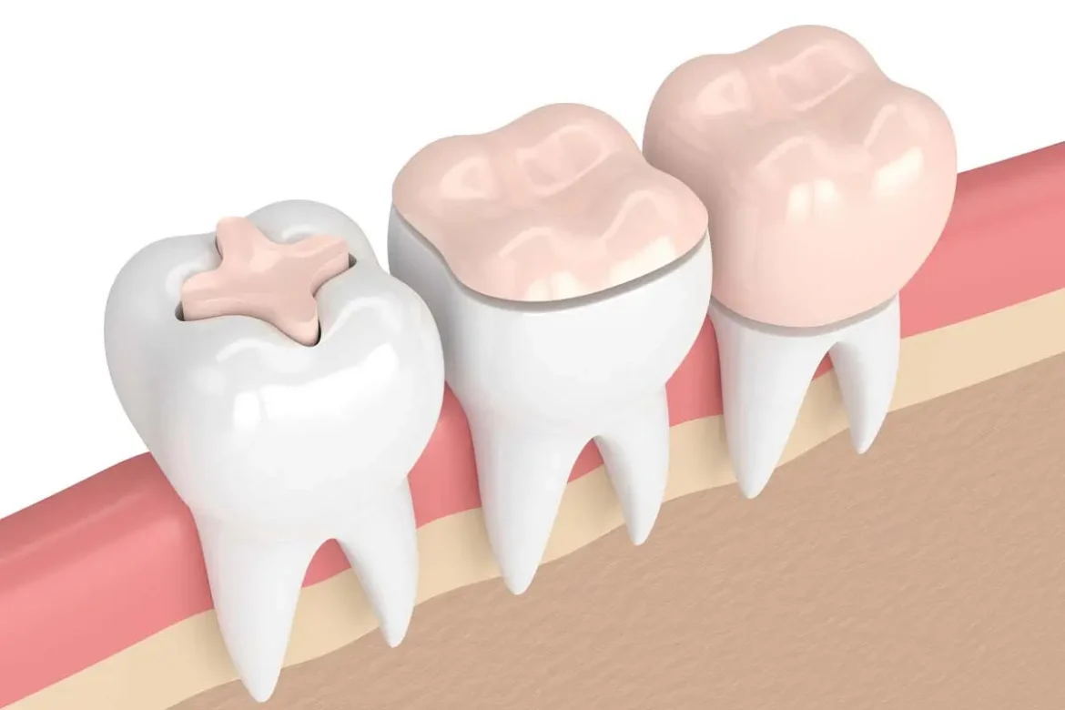 What Patients Should Know About a Broken Tooth